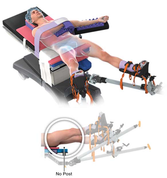 Fracture table and Pink Hip Kit example