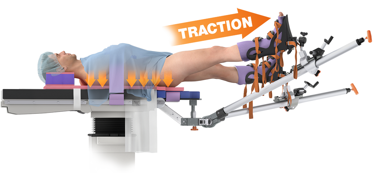 counter traction example