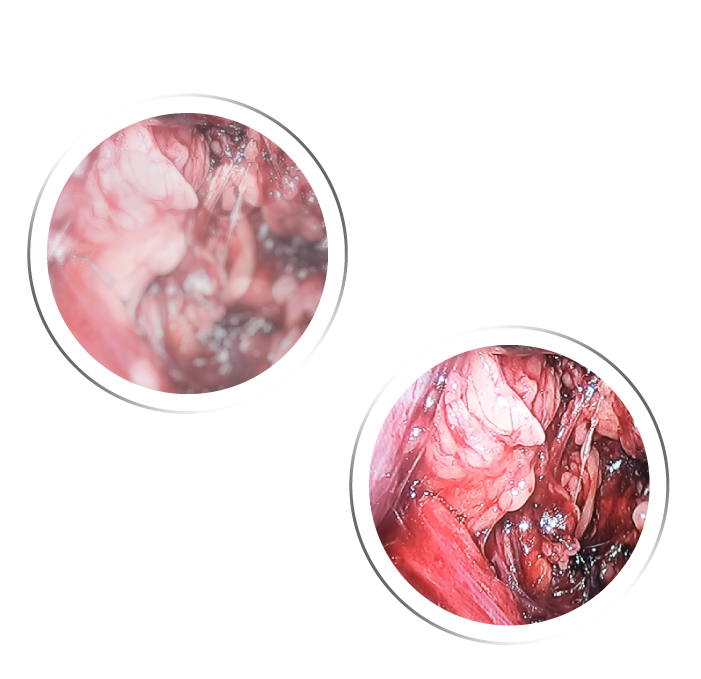 LAPAROSCOPIC VIEW before and after